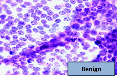 fna-benign1