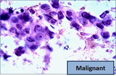 fna-malignant1