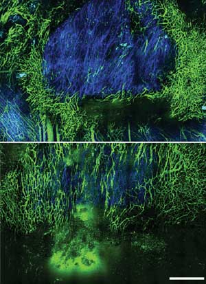 tumor vessel