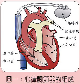 pacemaker