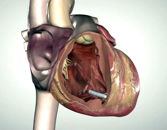 miniaturization pacemaker