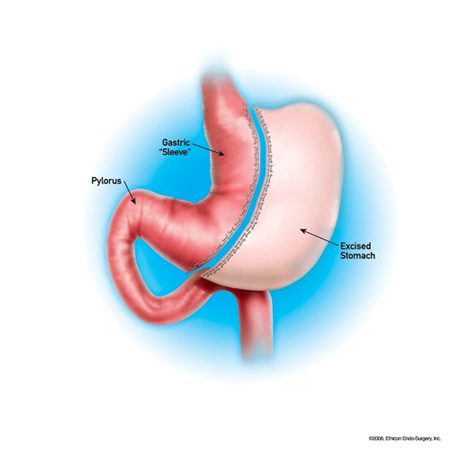 LAP_SleeveGastrectomy