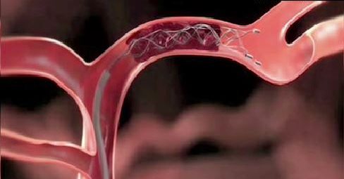 2015021301 stroke stents blood clot