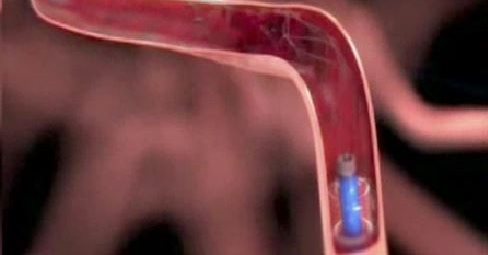 2015021302 stroke stents blood clot
