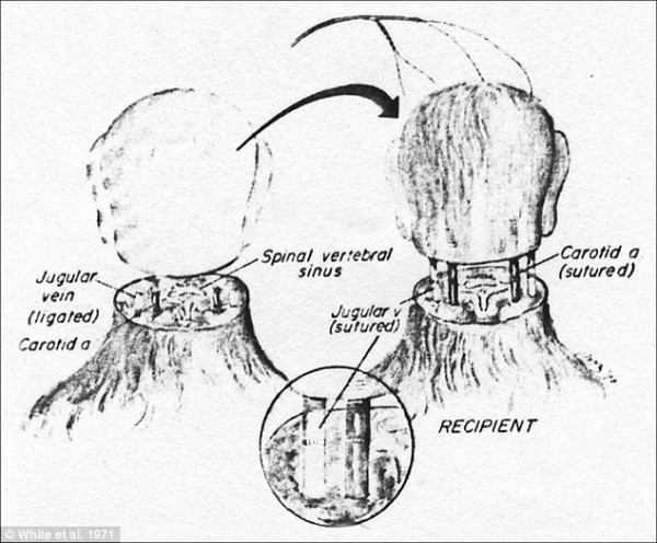 head transplant