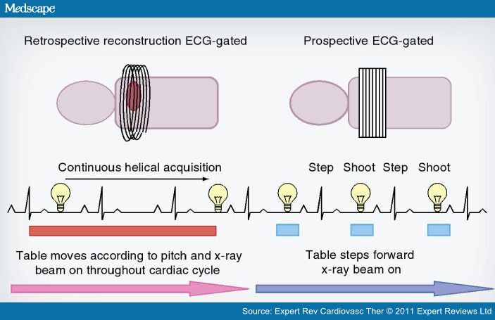 Prospective EKG triggering