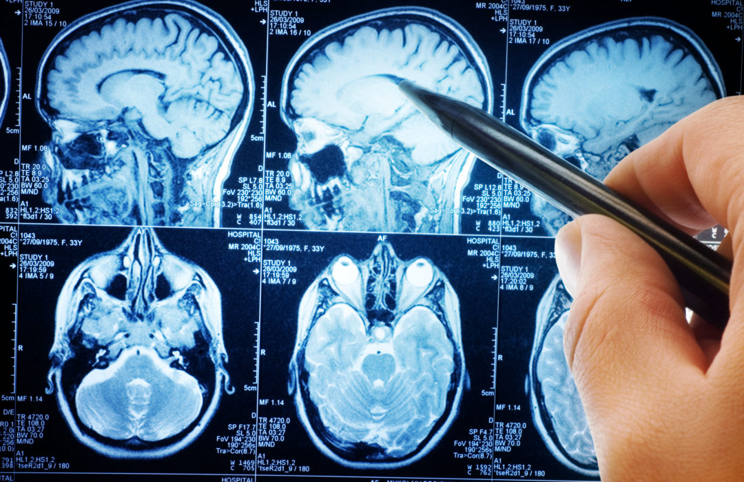 破解癲癇患者記憶衰退之謎，美團隊發現大腦夜間協調機制