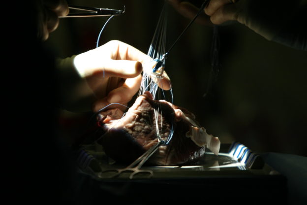 全球首例豬心移植人類失敗原因，可能是潛伏豬病毒