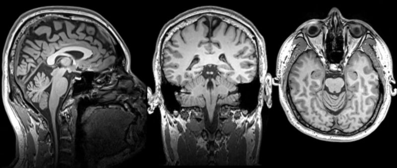 預防失智要注意！陽明交大最新研究與「口腔健康」有複雜關聯