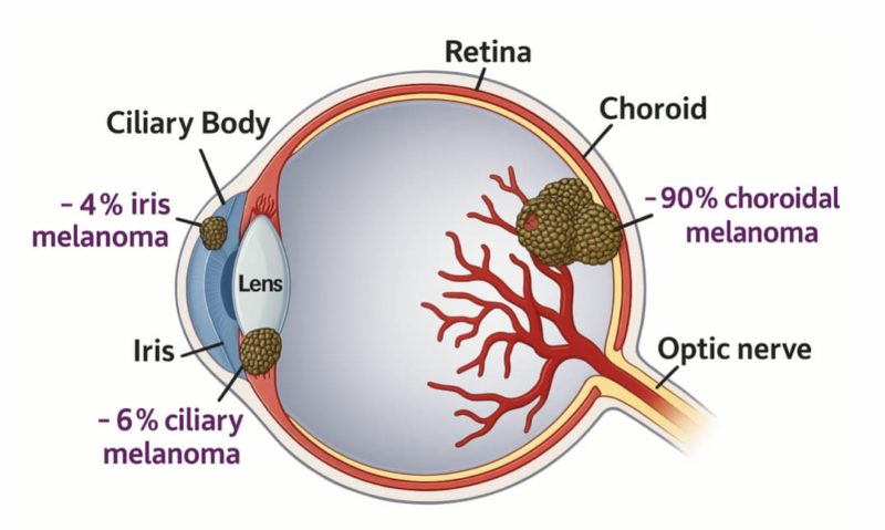 葡萄膜黑色素瘤新療法！彥臣子公司御華生醫新藥獲美國 FDA 孤兒藥認定